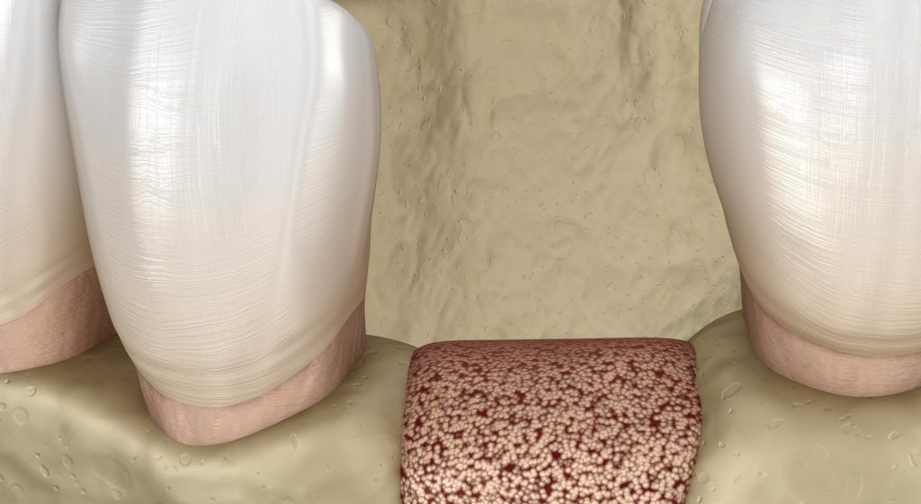 Greffe osseuse, comblement osseux à Paris et chirurgie buccale Dr Cohen