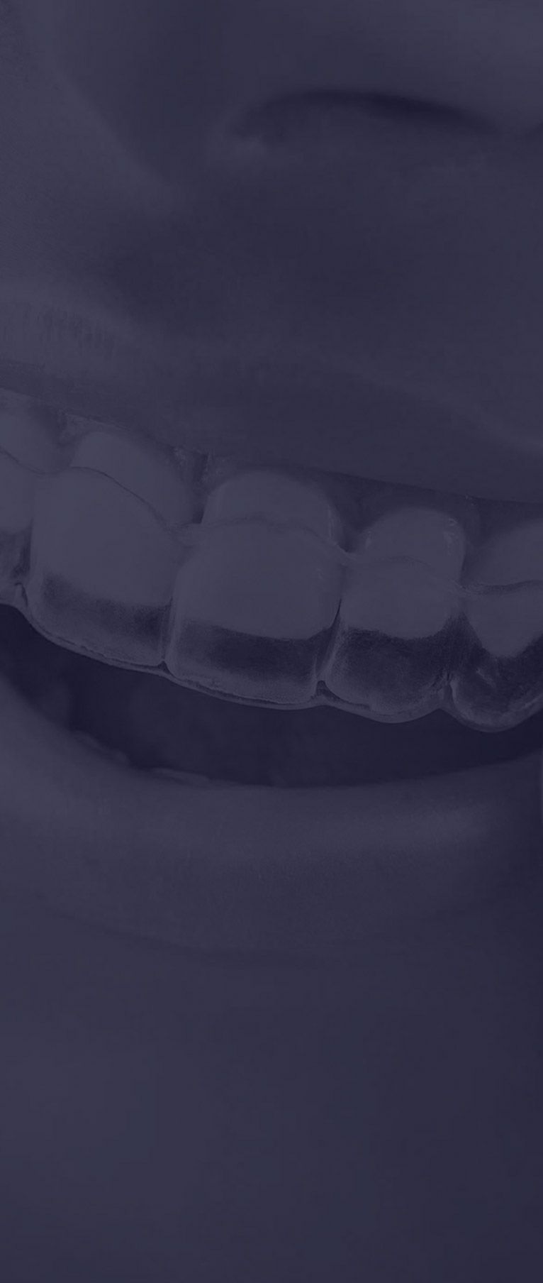 Alignement dentaire à Paris | Dr Cohen