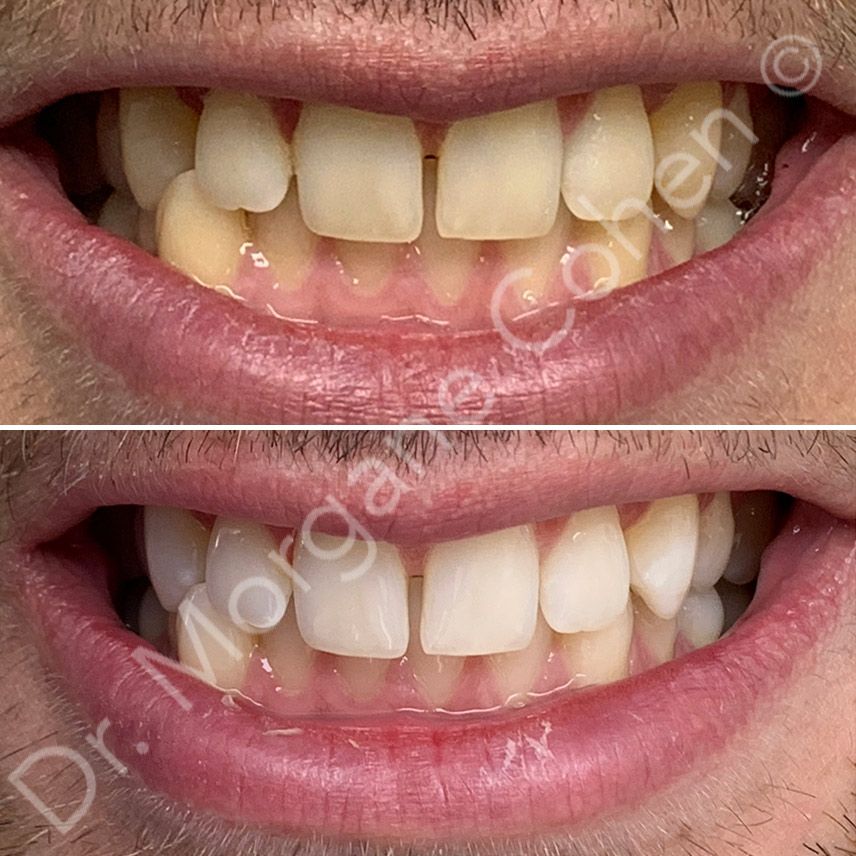Avant-après blanchiment dentaire 21 à Paris | Dr Cohen