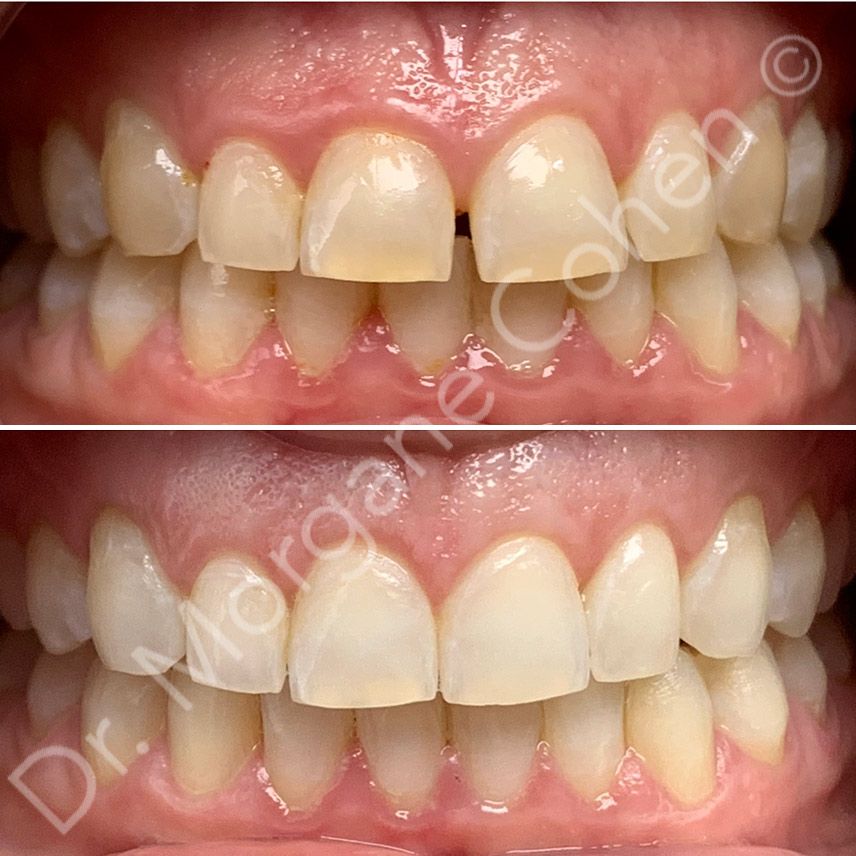 Avant-après invisalign 39 à Paris | Dr Cohen